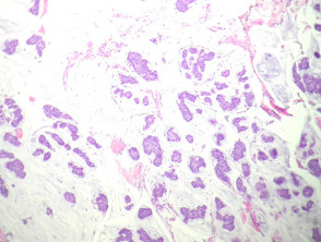 Mucinous carcinoma pathology