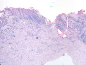 Mycetoma  pathology