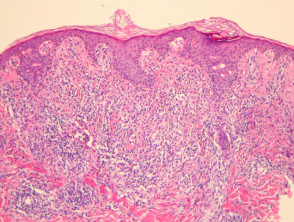 Extranodal NK/T cell lymphoma, nasal type pathology