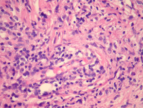 Extranodal NK/T cell lymphoma, nasal type pathology