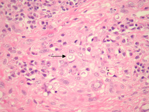 Paracoccidioidomycosis  pathology