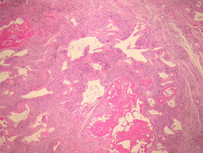 Pleomorphic Hyalinising Angiectatic Tumour (PHAT) pathology