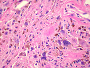 Pleomorphic Hyalinising Angiectatic Tumour (PHAT) pathology