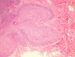 Pilar sheath acanthoma pathology