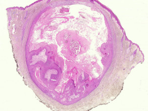 Proliferating epidermoid cyst pathology