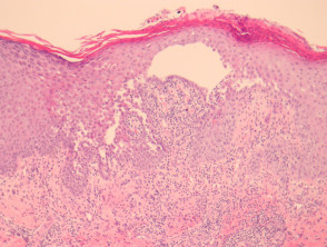 Pemphigus vulgaris pathology