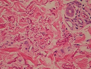 Pseudoxanthoma elasticum  pathology