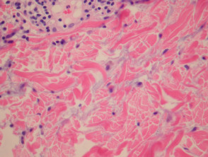 Reticular Erythematous Mucinosis pathology