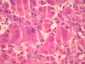 Reticulohistiocytoma pathology