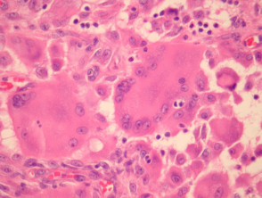 Reticulohistiocytoma pathology