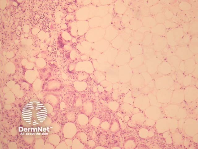 There is a lobular panniculitis and giant cells can be seen in the fat