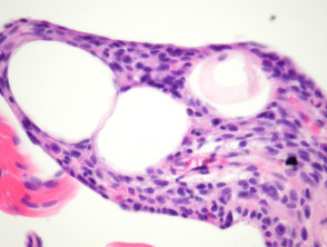 Spindle cell lipoma pathology