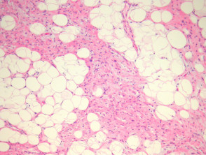 Spindle cell lipoma pathology