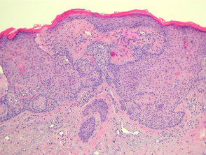 Tumour of the follicular infundibulum pathology