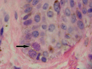 Toxoplasmosis   pathology