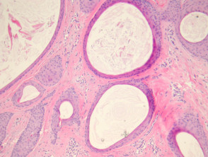 Trichoadenoma pathology