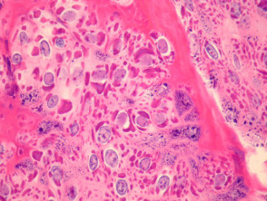 Verruca vulgaris   pathology