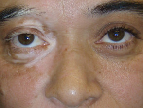 Segmental vitiligo
