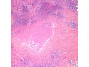 Granuloma annulare pathology