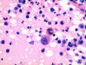 Herpes virus infection pathology