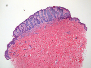 Syringofibroadenoma pathology