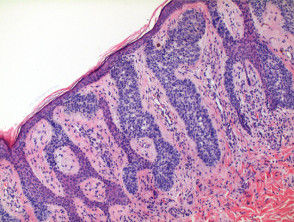 Syringofibroadenoma pathology