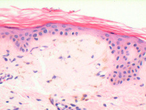 Primary cutaneous amyloidosis pathology