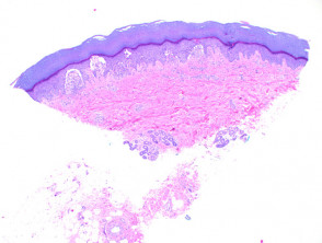 Dermatitis herpetiformis pathology