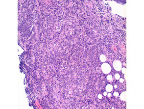 Primary cutaneous diffuse large B cell lymphoma pathology