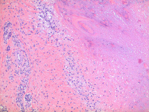 Rheumatoid nodule pathology