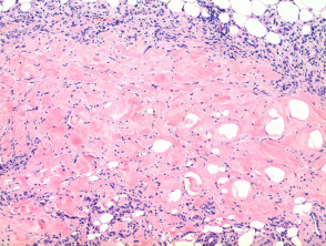 Necrobiosis lipoidica pathology