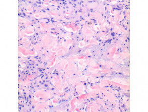 Granuloma annulare pathology