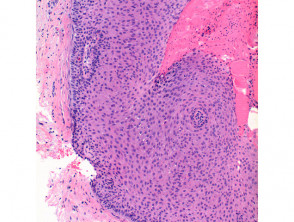 Pilar sheath acanthoma pathology