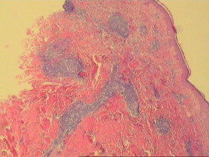 Pathology of erythema annulare centrifugum