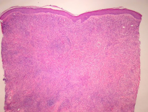 Erythema elevatum diutinum  pathology
