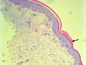 Pathology of erythema gyratum repens
