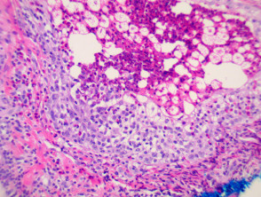 Eosinophilic pustular folliculitis pathology