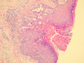 Transient acantholytic dermatosis or Grover disease pathology