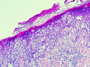Pathology of extramammary Paget disease
