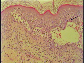 Pathology of toxic epidermal necrolysis