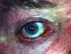 Pemphigus of eyelids