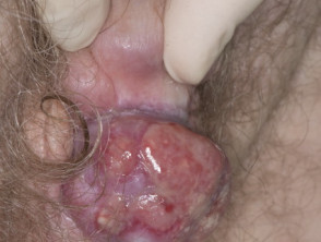 Penile squamous cell carcinoma