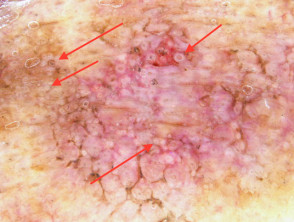Concentric circles (red arrows) seen in dermoscopy of pigmented actinic keratosis
