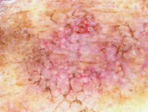 Dermoscopy of pigmented actinic keratosis