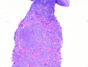 Plasmacytoma histology