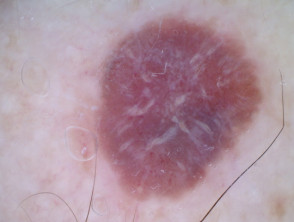Nodular amelanotic melanoma polarised dermoscopy view