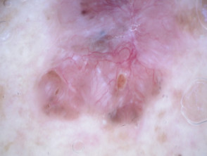 Polarised dermoscopy of pigmented basal cell carcinoma