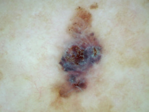 Polarised dermoscopy of melanoma