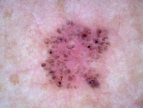 Polarised dermoscopy of pigmented basal cell carcinoma
