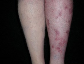 Camouflage of psoriasis